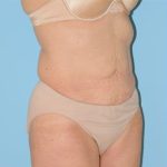 Abdominoplasty Before & After Patient #115