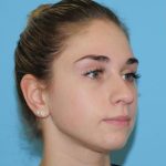 Rhinoplasty Before & After Patient #541