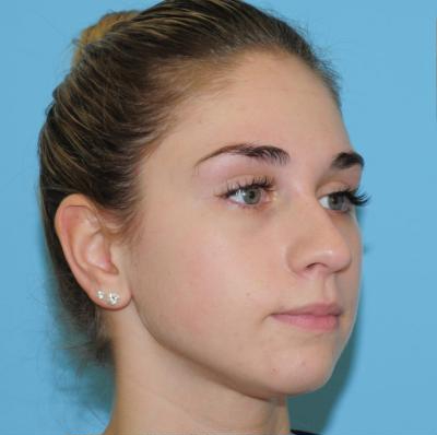 Rhinoplasty Before & After Patient #541