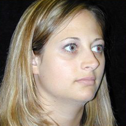 Rhinoplasty Before & After Patient #560