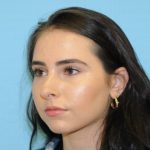 Rhinoplasty Before & After Patient #567