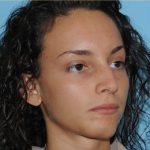 Rhinoplasty Before & After Patient #574