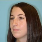 Rhinoplasty Before & After Patient #581