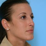 Rhinoplasty Before & After Patient #588