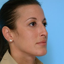 Rhinoplasty Before & After Patient #588
