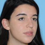Rhinoplasty Before & After Patient #595