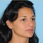 Rhinoplasty Before & After Patient #609