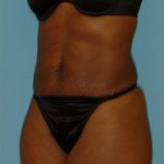 Abdominoplasty Before & After Patient #122