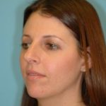 Rhinoplasty Before & After Patient #623