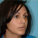 Rhinoplasty Before & After Patient #637