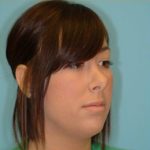 Rhinoplasty Before & After Patient #644