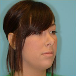 Rhinoplasty Before & After Patient #644