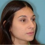 Rhinoplasty Before & After Patient #658