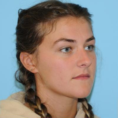 Rhinoplasty Before & After Patient #665