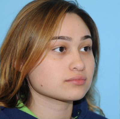 Rhinoplasty Before & After Patient #672