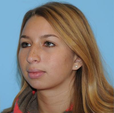 Rhinoplasty Before & After Patient #679