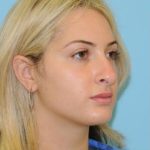 Rhinoplasty Before & After Patient #686