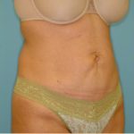 Abdominoplasty Before & After Patient #129