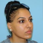 Rhinoplasty Before & After Patient #693