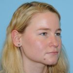Rhinoplasty Before & After Patient #707