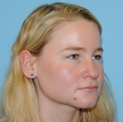 Rhinoplasty Before & After Patient #707
