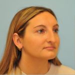 Rhinoplasty Before & After Patient #714
