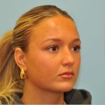 Rhinoplasty Before & After Patient #721