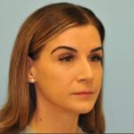Rhinoplasty Before & After Patient #728