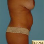 Abdominoplasty Before & After Patient #73