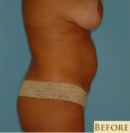 Abdominoplasty Before & After Patient #73