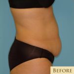 Abdominoplasty Before & After Patient #136