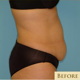 Abdominoplasty Before & After Patient #136