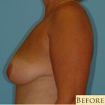 Mastopexy Before & After Patient #763