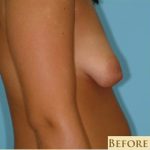 Mastopexy Before & After Patient #777
