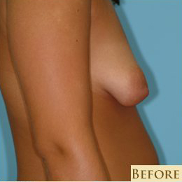 Mastopexy Before & After Patient #777