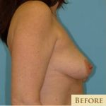 Mastopexy Before & After Patient #784