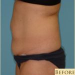 Abdominoplasty Before & After Patient #143