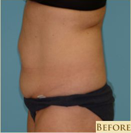 Abdominoplasty Before & After Patient #143