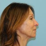 Facelift Before & After Patient #326