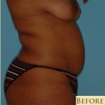 Abdominoplasty Before & After Patient #150