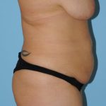 Abdominoplasty Before & After Patient #157