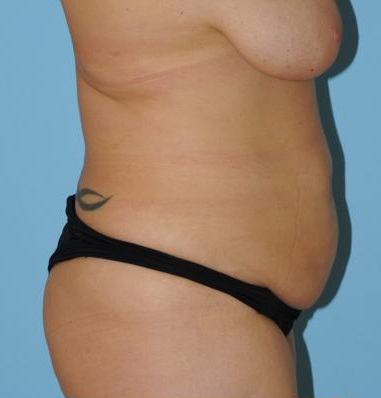 Abdominoplasty Before & After Patient #157