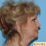 Facelift Before & After Patient #171