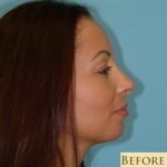 Blepharoplasty Before & After Patient #178