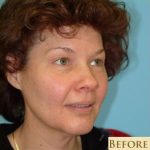 Blepharoplasty Before & After Patient #185