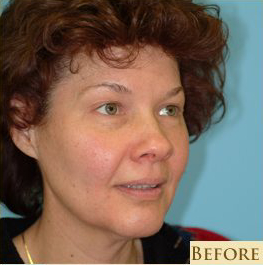 Blepharoplasty Before & After Patient #185
