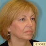 Blepharoplasty Before & After Patient #192