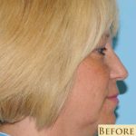 Blepharoplasty Before & After Patient #199