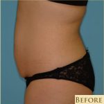 Abdominoplasty Before & After Patient #80