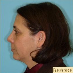 Facelift Before & After Patient #206